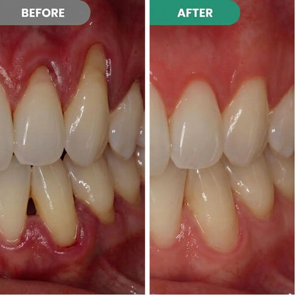 ToothSeal™ | Gum Repair Gel