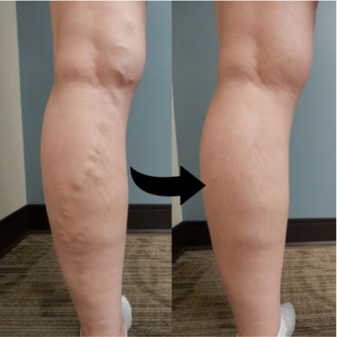 VeinEase™ | Varicose Veins Cream