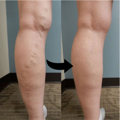 VeinEase™ | Varicose Veins Cream