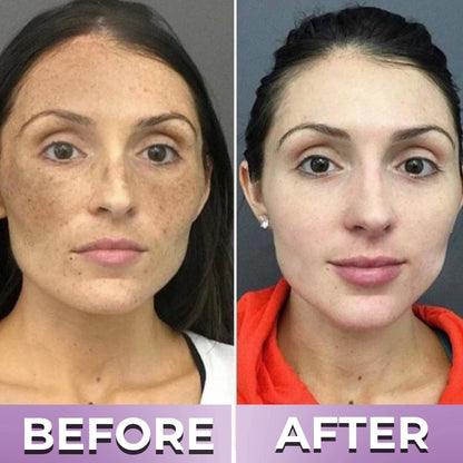 BrillaSkin™ | Advanced Anti-Hyperpigmentation Cream