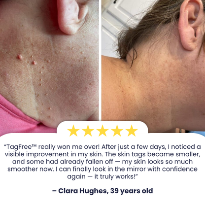 TagFree™ | Cryotherapy Skin Tag Remover Spray