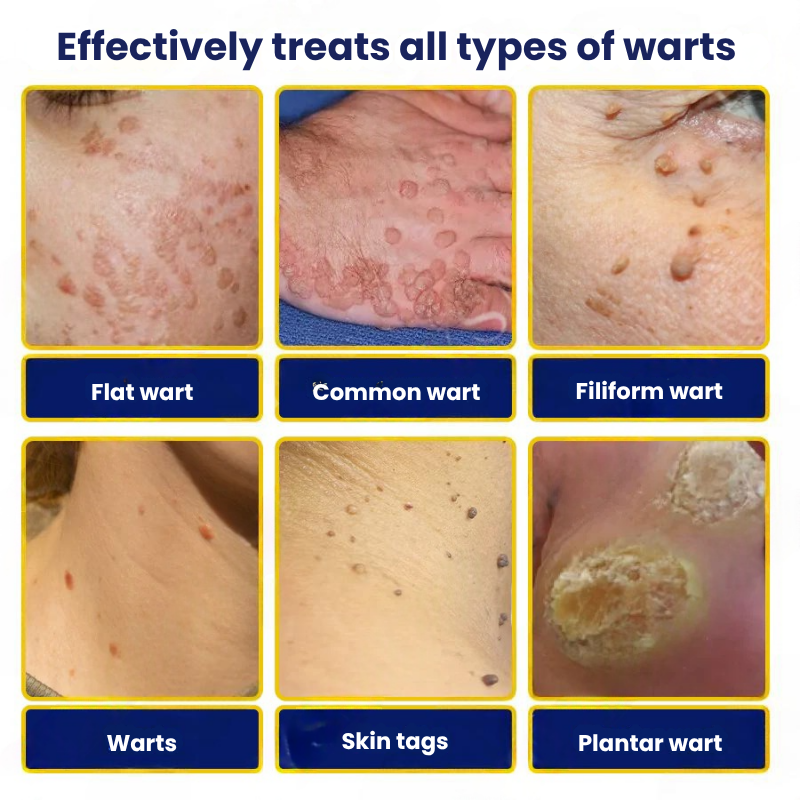 TagFree™ | Cryotherapy Skin Tag Remover Spray