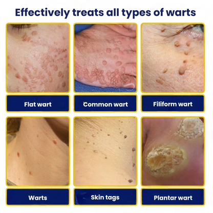 TagFree™ | Cryotherapy Skin Tag Remover Spray