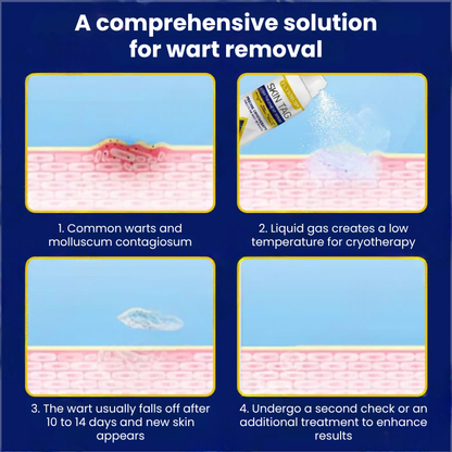 TagFree™ | Cryotherapy Skin Tag Remover Spray