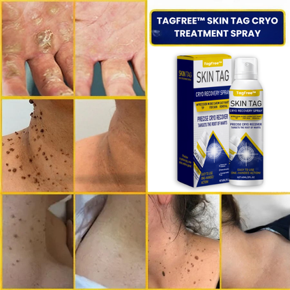 TagFree™ | Cryotherapy Skin Tag Remover Spray