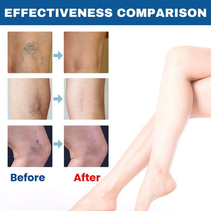 VenoAid™ | Varicose Vein Solution Spray