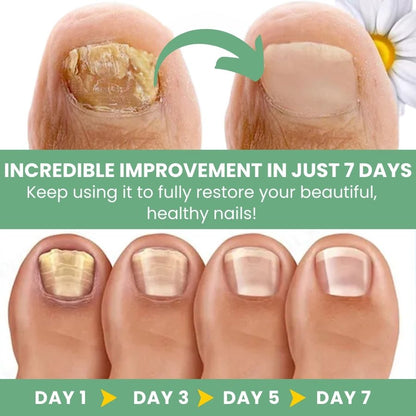 FungBoost™ | Nail Fungus Treatment Gel