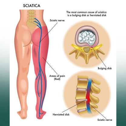 SciaEase™ | Natural Sciatica Cream