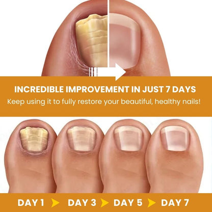 FungiHeal™ |  Nail Fungus Treatment Spray