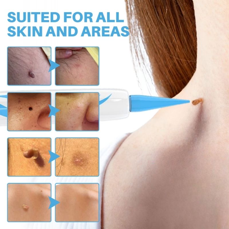 TagSlip™ | Painless Skin Tag Remover