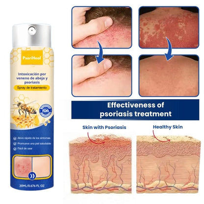 PsoriHeal™ | Psoriasis and Eczema Treatment Spray