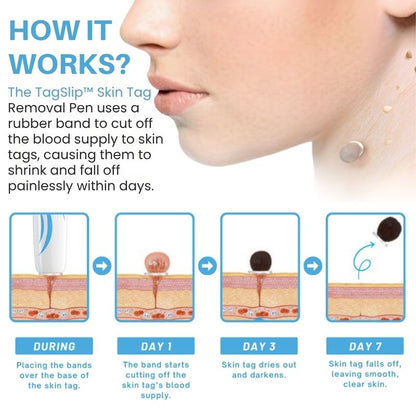 TagSlip™ | Painless Skin Tag Remover
