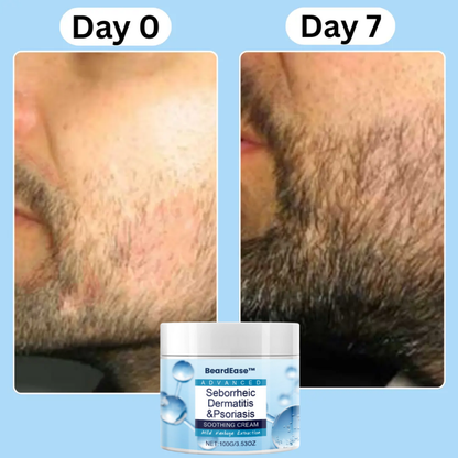 BeardEase™ | Soothing Beard Relief Cream