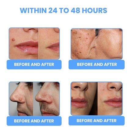 LaserPen™ | Precision Plasma Skin Corrector