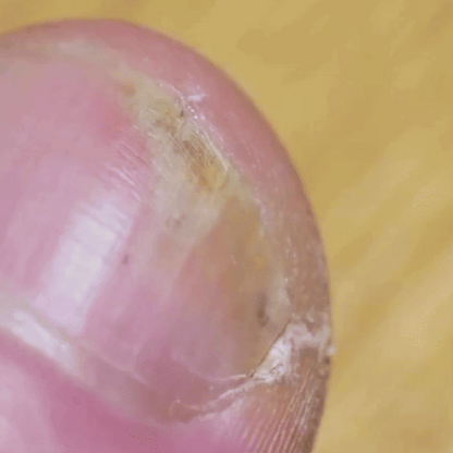 NailVive™ | Toenil Fungus Pen